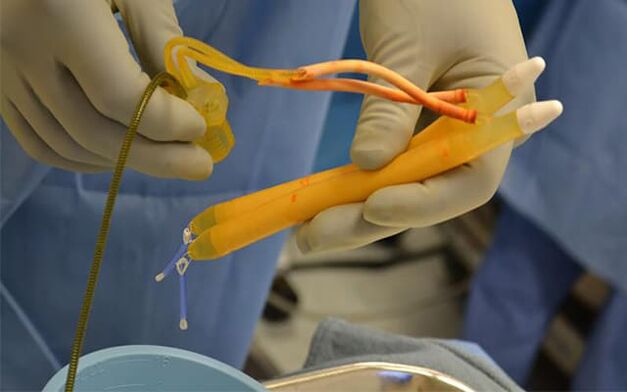 Implants dans le pénis