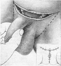 Allongement chirurgical du pénis par arrachage de sa partie cachée